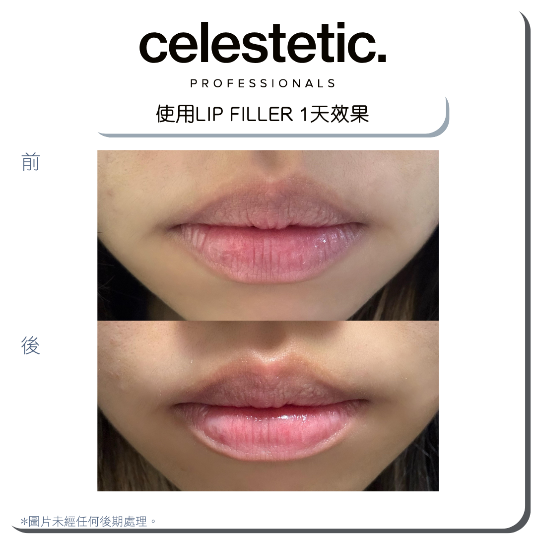 Lip Filler 天然無針豐水亮潤唇膏 (NEW)