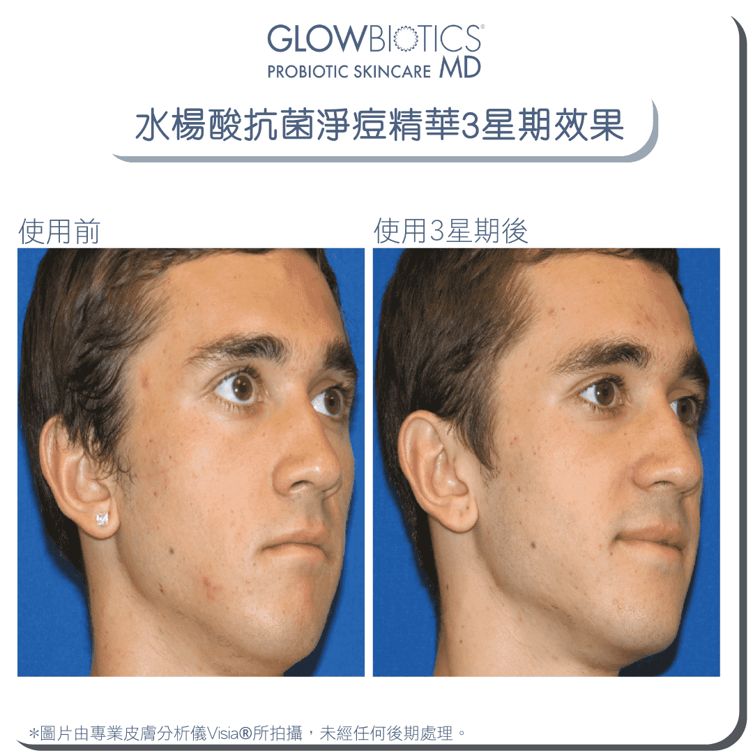 水楊酸抗菌淨痘精華 - Derm - Mart