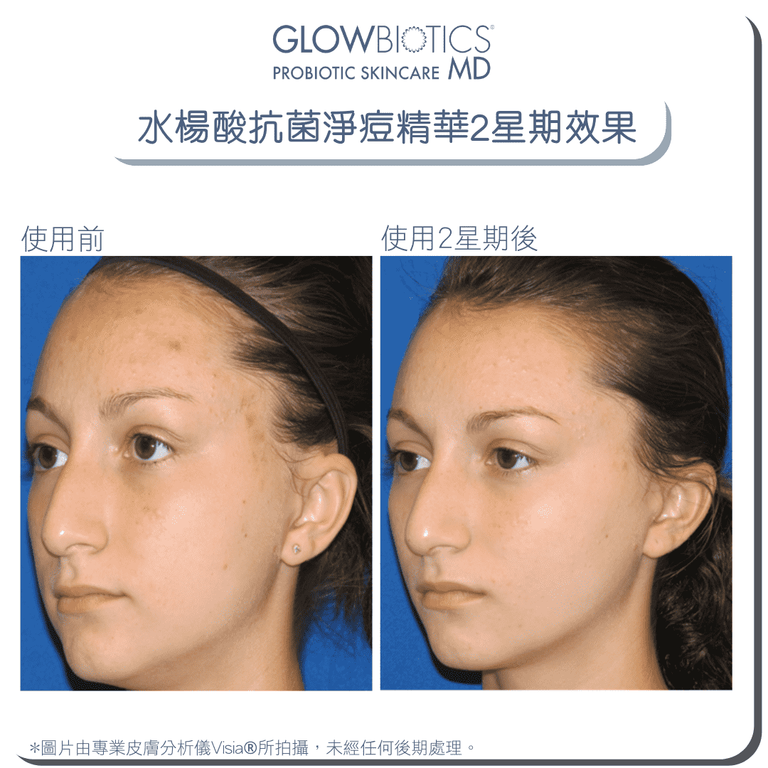 水楊酸抗菌淨痘精華 - Derm - Mart