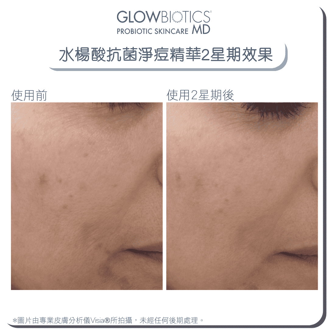 水楊酸抗菌淨痘精華 - Derm - Mart