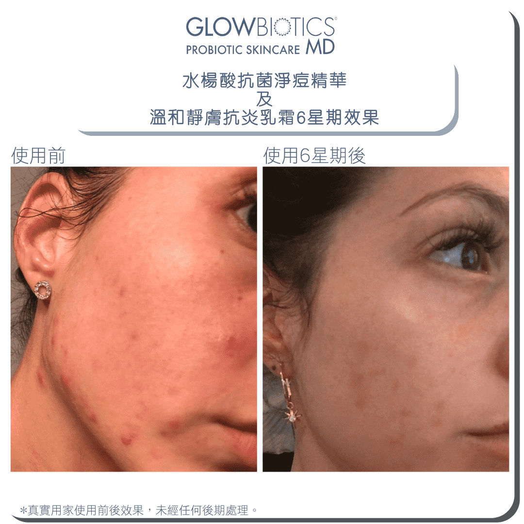 水楊酸抗菌淨痘精華 - Derm - Mart