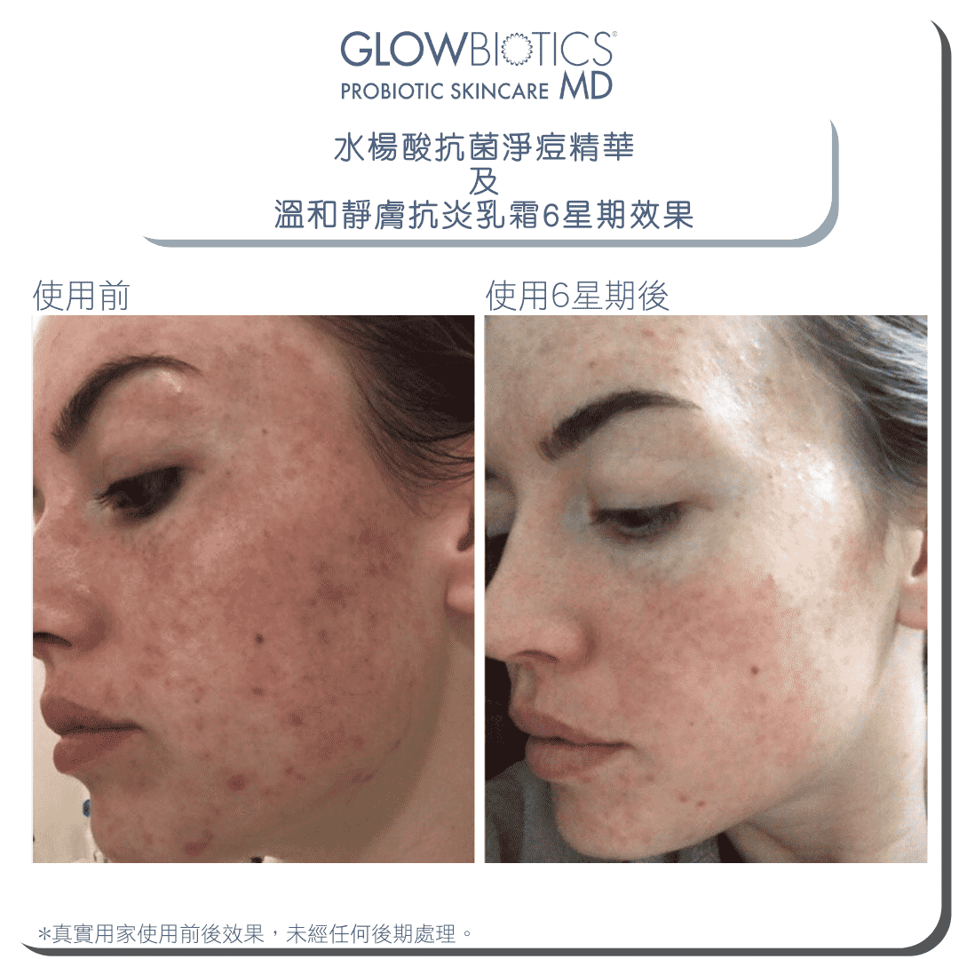 水楊酸抗菌淨痘精華 - Derm - Mart