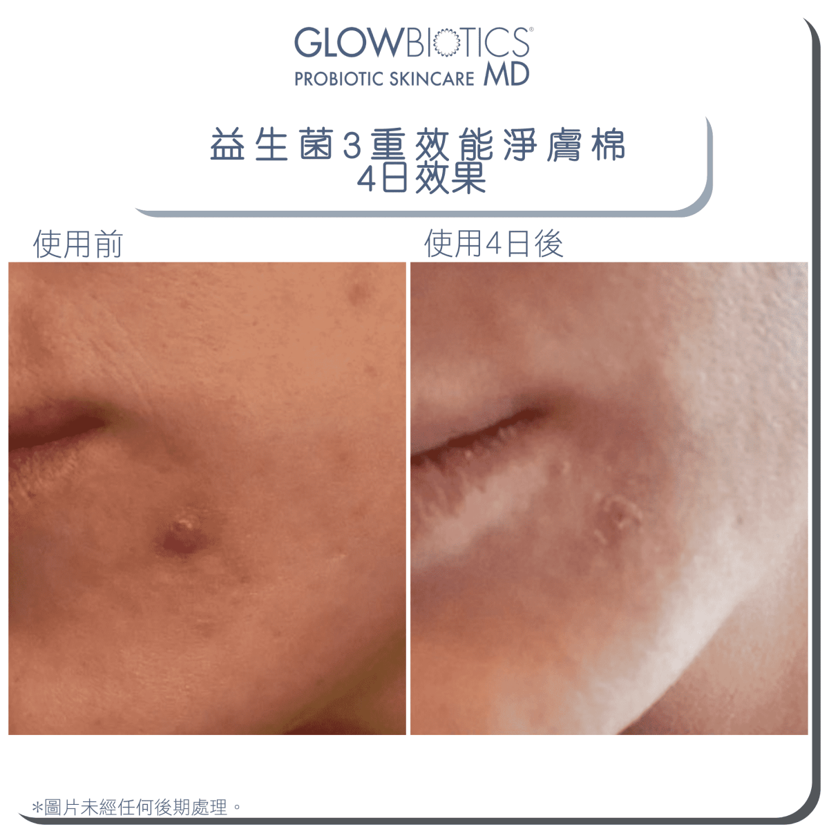 益生菌3重效能淨膚棉 - Derm - Mart