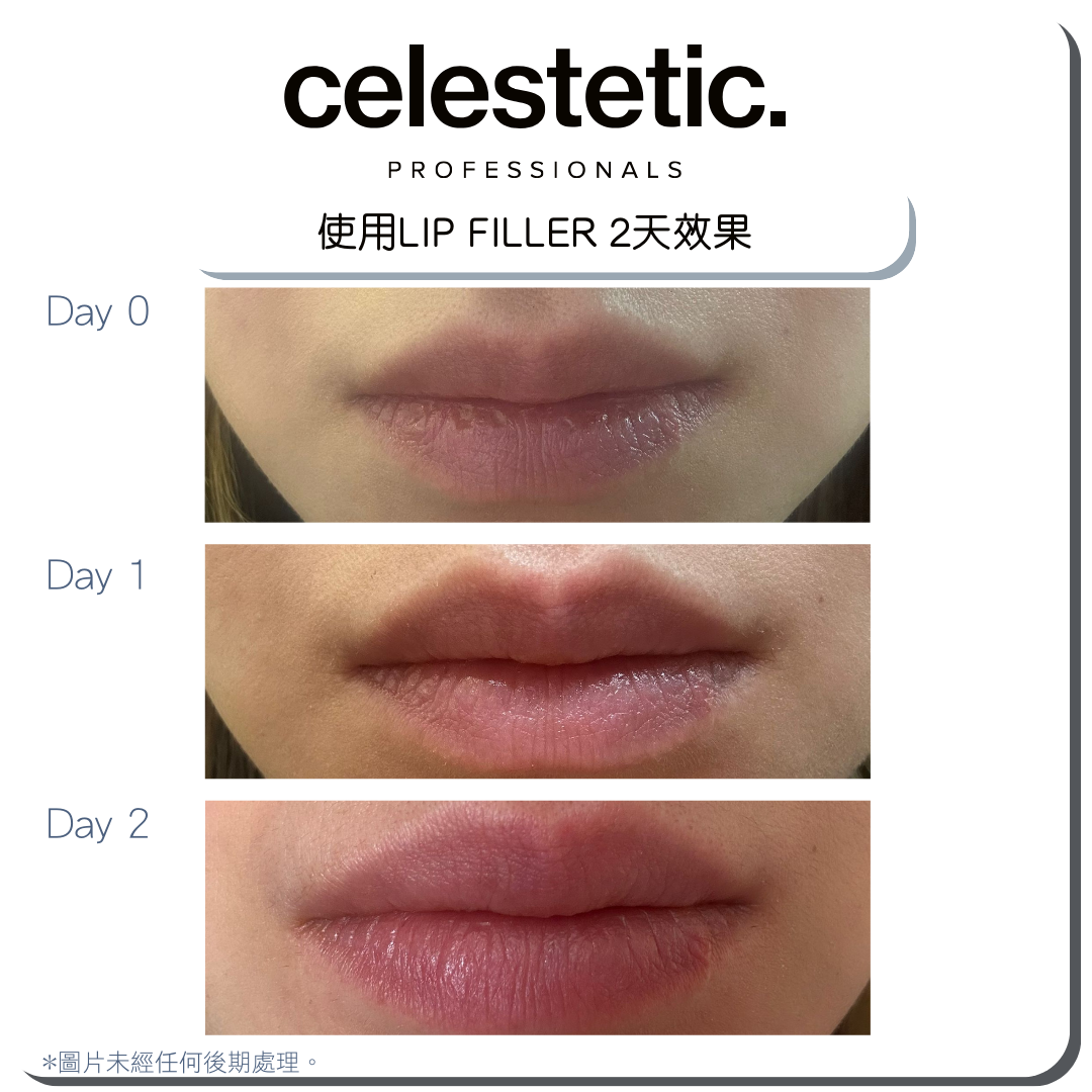 Lip Filler 天然無針豐水亮潤唇膏 (NEW)